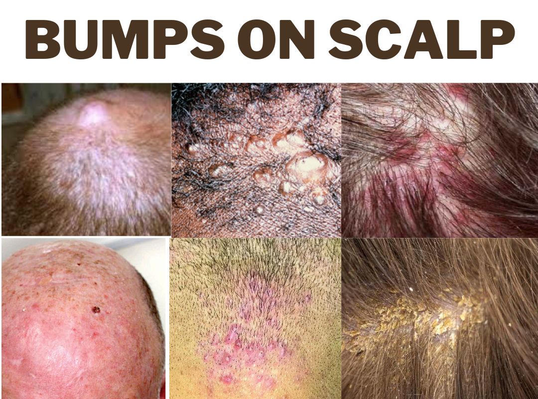 Understanding And Dealing With Bumps On Scalp 